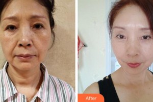 杭州東方整形外科門(mén)診部魏端欽整形價(jià)格表附埋線提升案例展示