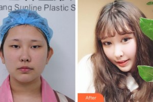 杭州格萊美整形美容醫(yī)院孫商燮整形價(jià)格表附切開(kāi)雙眼皮案例展示