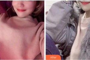 杭州美萊醫(yī)療美容醫(yī)院姜貴杰整形價(jià)格表附超聲波潔牙案例展示