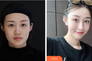 杭州靜港醫(yī)療美容診所程衛(wèi)民整形價(jià)格表附埋線提升案例展示