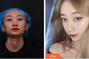 杭州韓佳醫(yī)療整形門(mén)診部樸相恩整形價(jià)格表附鼻部綜合案例展示