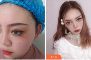 杭州韓佳醫(yī)療整形門(mén)診部柳垣在整形價(jià)格表附鼻部綜合案例展示