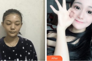 杭州艾菲醫(yī)療美容門診部鄭義澤整形價格表附種植發(fā)際線案例展示