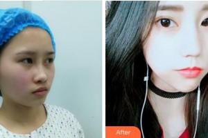 杭州顏術(shù)悅?cè)葆t(yī)療美容診所付俊整形價格表附埋線提升案例展示