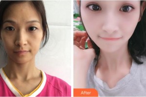 杭州格萊美整形美容醫(yī)院鄭小紅整形價格表附眼部綜合案例展示
