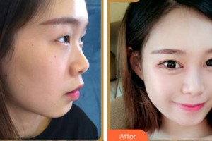 杭州珍美顏醫(yī)療美容診所謝菁整形價格表附眼部綜合案例展示