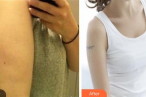 杭州冰美醫(yī)療美容醫(yī)院樓善葉整形價格表附吸脂案例展示