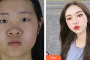 杭州華廈眼科醫(yī)院黃旭整形價格表附眼部綜合案例展示