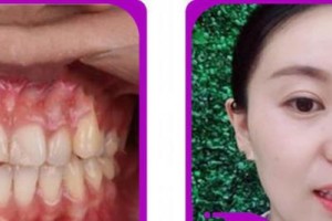 杭州美奧口腔門診部張彼得整形價(jià)格表附牙齒隱形矯正案例展示