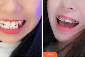 杭州美奧口腔門診部高思奇整形價(jià)格表附金屬托槽矯正案例展示