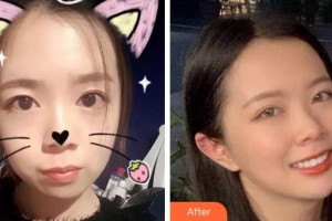 杭州富陽(yáng)柏氏眼科醫(yī)院柏硯農(nóng)整形價(jià)格表附金屬托槽矯正案例展示