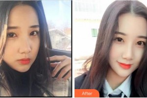 杭州牙科醫(yī)院畢文翔整形價(jià)格表附冷光美白案例展示