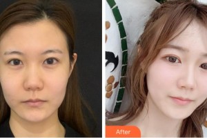 杭州嬋之媛醫(yī)療美容診所孫華昌整形價格表附熱瑪吉案例展示