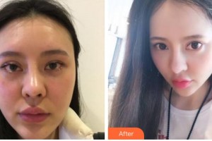 杭州依萱綺醫(yī)療美容診所黃高敏整形價格表附抗衰老案例展示