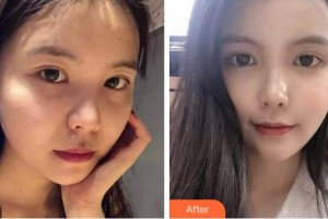 杭州依萱綺醫(yī)療美容診所李營整形價格表附熱瑪吉案例展示