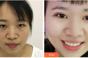 杭州華廈眼科醫(yī)院陳偕穗整形價格表附定點雙眼皮案例展示