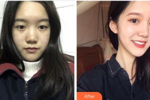 杭州華廈眼科醫(yī)院陳彬彬整形價格表附眼部綜合案例展示