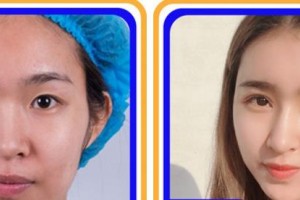 杭州華廈眼科醫(yī)院孫佳黎整形價格表附眼部綜合案例展示