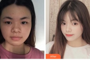 杭州睿妍醫(yī)療美容診所周蓉蓉整形價格表附埋線提升案例展示