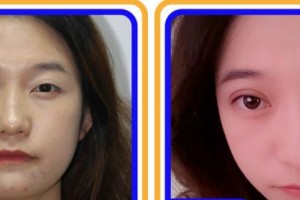 杭州來美安醫(yī)療美容門診部王恒整形價格表附眼部綜合案例展示