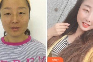 杭州富陽柏氏眼科醫(yī)院馬麗卿整形價格表附內(nèi)切祛眼袋案例展示