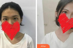 杭州富陽柏氏眼科醫(yī)院王劍勇整形價格表附切開雙眼皮案例展示