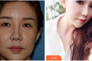 杭州求是眼科醫(yī)院張洪勛整形價格表附外切祛眼袋案例展示