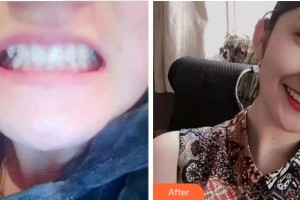 杭州品凱口腔醫(yī)院朱強(qiáng)整形價(jià)格表附牙齒陶瓷矯正案例展示