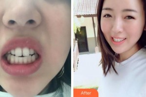 杭州品凱口腔醫(yī)院李宏偉整形價(jià)格表附金屬托槽矯正案例展示