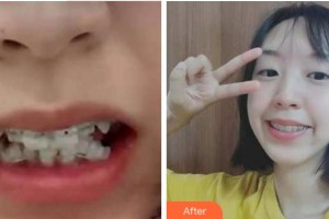 杭州品凱口腔醫(yī)院鄭志春整形價(jià)格表附牙齒陶瓷矯正案例展示