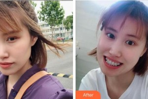 杭州品凱口腔醫(yī)院劉鋼才整形價(jià)格表附金屬托槽矯正案例展示