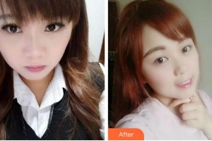 杭州品凱口腔醫(yī)院張存好整形價(jià)格表附牙齒隱形矯正案例展示