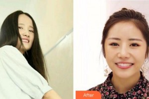 杭州市富陽(yáng)區(qū)第一人民醫(yī)院燒傷整形外科唐曉明整形價(jià)格表附牙齒隱形矯正案例展示