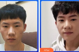 杭州市富陽(yáng)區(qū)中醫(yī)院眼科張建亨整形價(jià)格表附切開雙眼皮案例展示