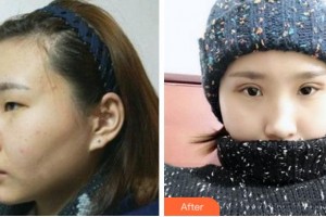 杭州市富陽(yáng)區(qū)中醫(yī)院眼科王琴素整形價(jià)格表附切開雙眼皮案例展示