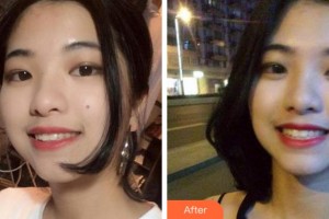 杭州富陽(yáng)口腔醫(yī)院葉寶定整形價(jià)格表附牙齒隱形矯正案例展示