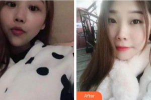 杭州富陽(yáng)口腔醫(yī)院賈珂整形價(jià)格表附自鎖托槽矯正案例展示