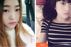 杭州亮貝美口腔醫(yī)院趙媛整形價(jià)格表附金屬托槽矯正案例展示