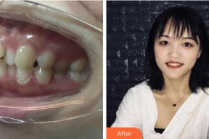 杭州臻好口腔門診部徐丹整形價(jià)格表附金屬托槽矯正案例展示
