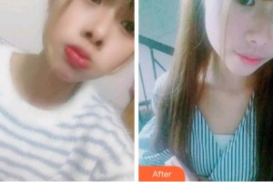 杭州亮貝美口腔醫(yī)院蔣賢軍整形價(jià)格表附根管調(diào)節(jié)案例展示