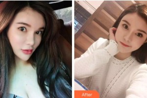 杭州良渚口腔門診部馮陳剛整形價(jià)格表附超聲波潔牙案例展示