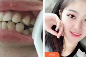 杭州博凡口腔門診部林毅整形價格表附金屬托槽矯正案例展示