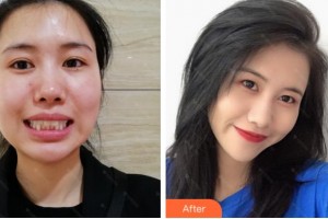 杭州西湖口腔醫(yī)院葉論整形價格表附牙齒隱形矯正案例展示