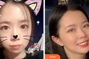 杭州西湖口腔醫(yī)院陳宏軍整形價格表附金屬托槽矯正案例展示