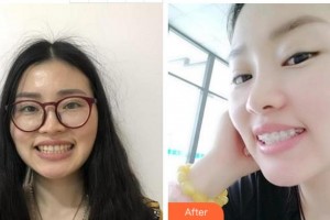 杭州西湖口腔醫(yī)院武鑫茹整形價格表附金屬托槽矯正案例展示