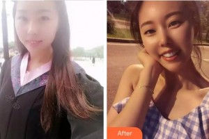 杭州西湖口腔醫(yī)院王城整形價格表附牙齒陶瓷矯正案例展示