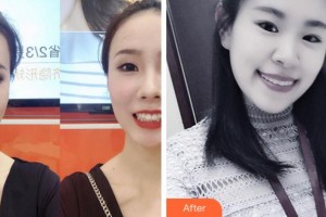 杭州西湖口腔醫(yī)院王慧敏整形價格表附牙齒隱形矯正案例展示