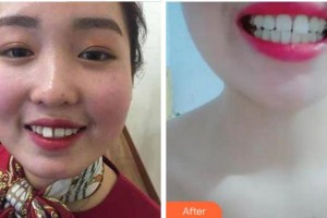 杭州國雅口腔醫(yī)院萬成鋒整形價格表附牙齒隱形矯正案例展示