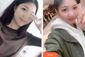 杭州國雅口腔醫(yī)院張虹整形價格表附根管調(diào)節(jié)案例展示