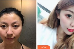 杭州太學(xué)眼科門診部邱培瑾整形價格表附上眼瞼去脂案例展示